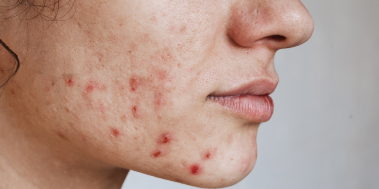 Period Acne? Not Anymore! 4 Derm-Approved Products That Work!