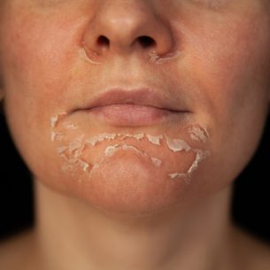 Chemical Peels – Social Media: Separating Fact from Fiction